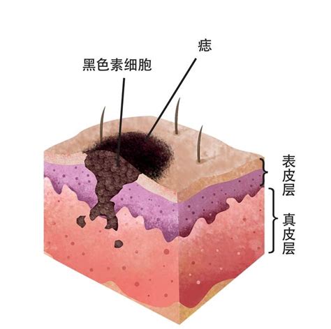 痣是怎麼形成的